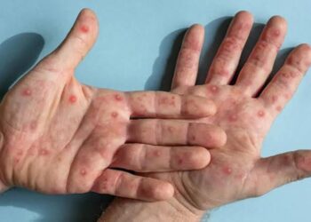 RSUD Bontang Gencarkan Sosialisasi Cacar Monyet, Edukasi Masyarakat untuk Pencegahan Dini