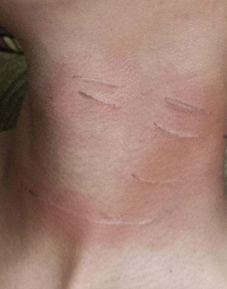 Nyaris Kecelakaan di Rawa Indah Terjerat Benang Layangan, Alami Luka Sayat di Leher